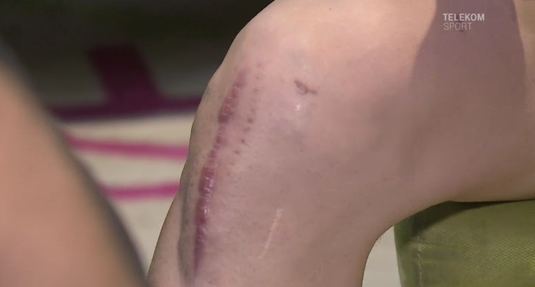 Video HORROR! Cum poate arăta piciorul lui Florin Gardoş după sute de zile pierdute din cauza accidentărilor: "M-am gândit să mă retrag"