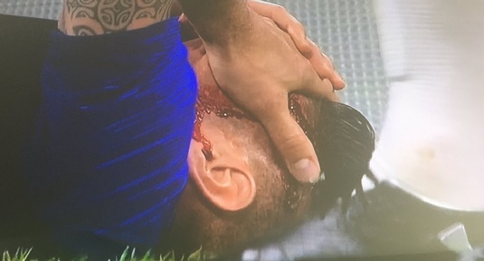 VIDEO | Imagini şocante de la amicalul Franţa - SUA! Giroud a fost umplut de sânge după ce s-a lovit cap în cap cu un adversar