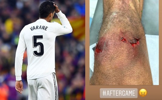 FOTO ŞOCANT | El Clasico a lăsat urme adânci. Piciorul lui Varane arată groaznic după partida cu Barcelona
