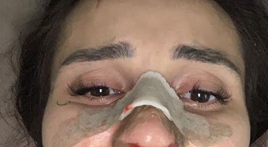 FOTO | Un jucător şi-a bătut crunt iubita: ”Mi-a rupt intenţionat nasul!” Dezvăluirile şocante ale tinerei