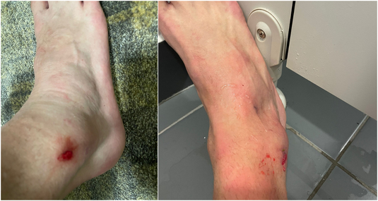 Cum arată piciorul lui Bogdan Chipirliu după ce a ieşit accidentat. Rana căpătată în urma fazei în care arbitrul n-a arătat nici măcar cartonaşul galben | FOTO EXCLUSIV