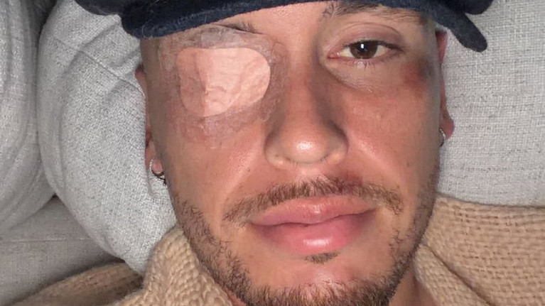 Argentinianul Lucas Ocampos are paralizie facială pe partea stângă