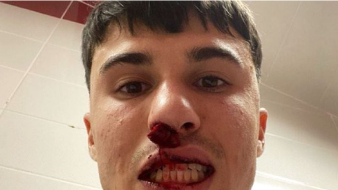 FOTO ǀ Cum arată Alessandro Bianco, după ce a fost lovit de un suporter advers 