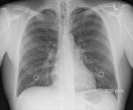 VIDEO Sănătate cu stil: Fibroza pulmonară, „ucigaşul” plămânilor