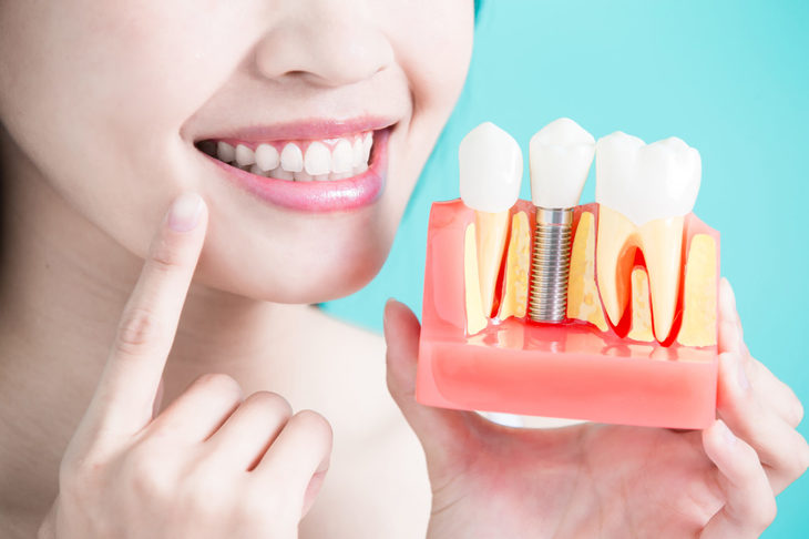 COMUNICAT. Ce este un implant dentar si care sunt tipurile potrivite in functie de caz