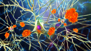 O nouă abordare în tratamentul unor boli neurodegenerative precum Parkinson şi Alzheimer