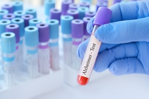 Un test de sânge care poate depista boala Alzheimer, autorizat în SUA