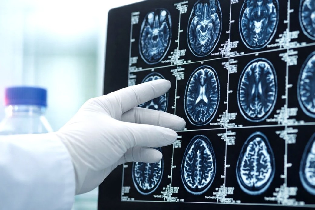 Virusul care provoacă Covid-19 poate lăsa modificări detectabile în creier, chiar şi după o recuperare completă