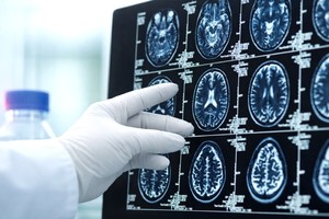 Virusul care provoacă Covid-19 poate lăsa modificări detectabile în creier, chiar şi după o recuperare completă