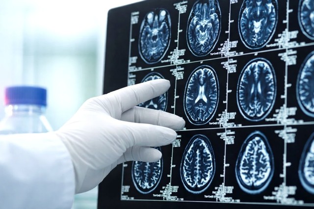 Virusul care provoacă Covid-19 poate lăsa modificări detectabile în creier, chiar şi după o recuperare completă