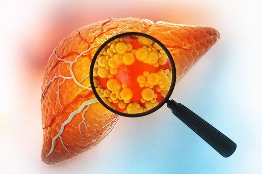 Mecanismul prin care obezitatea declanşează inflamaţia cronică, identificat de cercetători