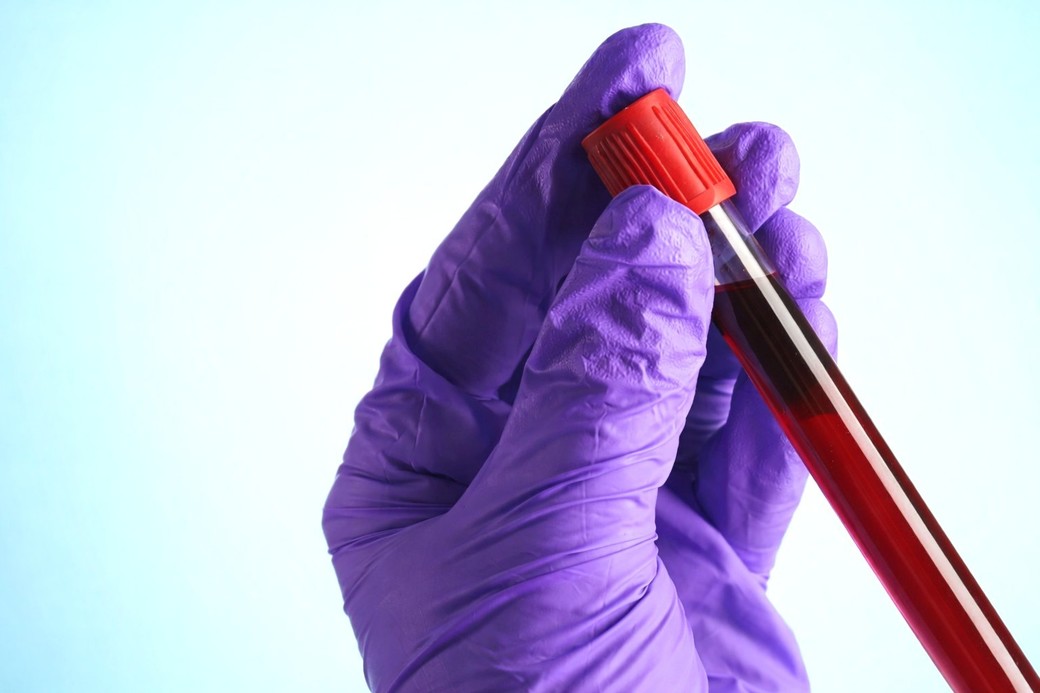 Ce este hemocromatoza şi cum poate duce la afectarea organelor
