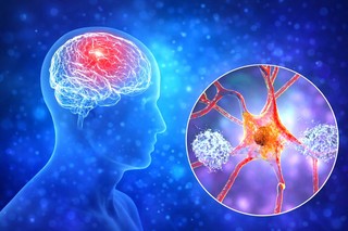 VIDEO Un proces toxic timpuriu în Alzheimer ar putea fi blocat cu un medicament deja aprobat