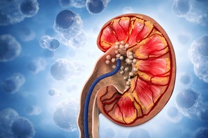 De ce consumul crescut de apă nu este suficient pentru a preveni reapariţia pietrelor la rinichi