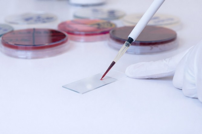 Incidenţa leucemiei asociate tratamentului oncologic: rezultatele unui studiu pe 30 de ani