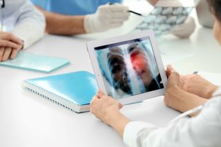 Detectarea precoce a cancerului pulmonar cu un nou instrument de screening