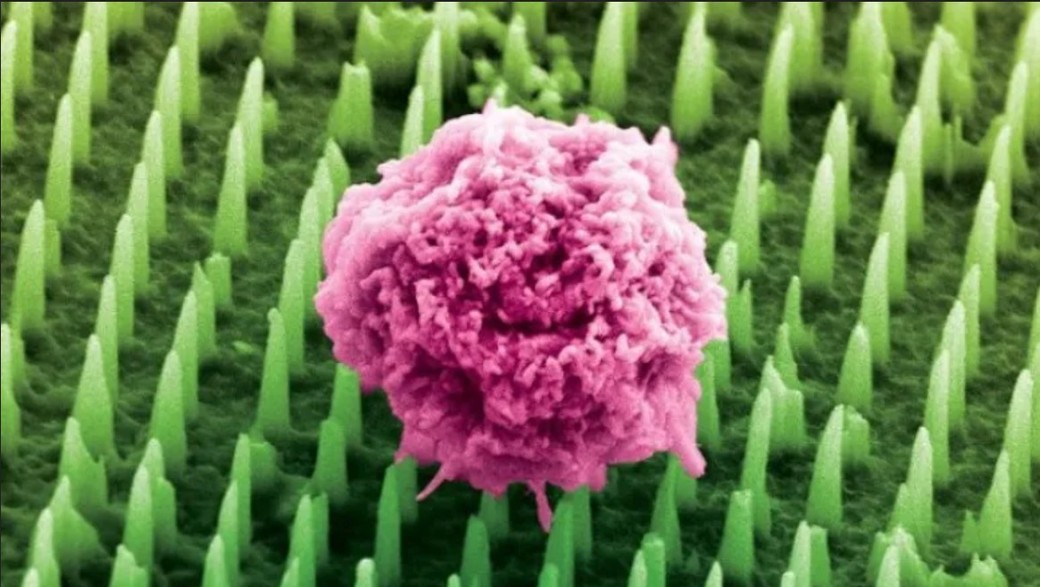Sfârşitul biopsiilor tradiţionale? O nouă inovaţie promite un diagnostic fără durere pentru boli grave precum cancerul şi Alzheimer
