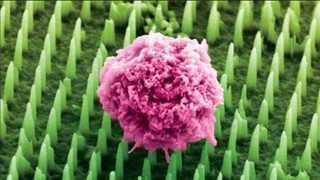 Sfârşitul biopsiilor tradiţionale? O nouă inovaţie promite un diagnostic fără durere pentru boli grave precum cancerul şi Alzheimer