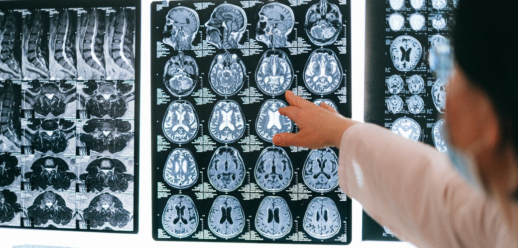 Terapia cu ultrasunete ar putea creşte şansele de supravieţuire după un AVC