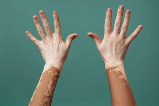 Cercetătorii avansează o terapie care poate restabili pigmentarea pielii la pacienţii cu vitiligo