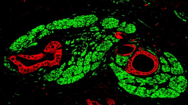 驚くべき発見：膵臓腫瘍はがんの増殖を刺激する「偽シナプス」を介して神経系に接続している