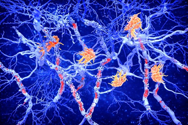 Două subtipuri noi de scleroză multiplă, identificate cu ajutorul inteligenţei artificiale