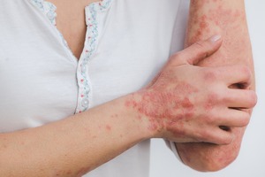 O nouă potenţială opţiune de tratament pentru psoriazis 