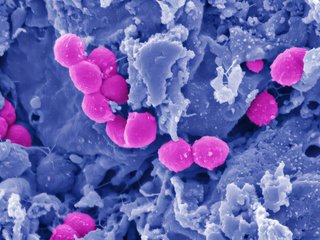 Cercetătorii au descoperit un inhibitor care blochează bacteriile carnivore, reducând deteriorarea ţesuturilor în cazul infecţiilor
