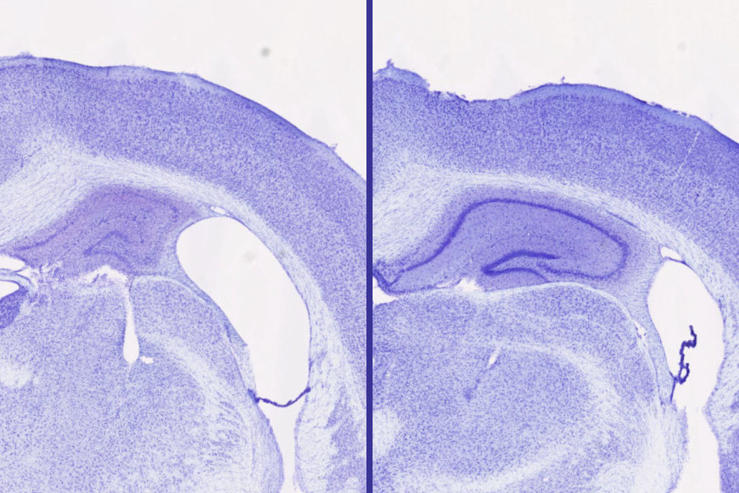 Un somnifer comun ar putea încetini procesele neurodegenerative asociate bolii Alzheimer