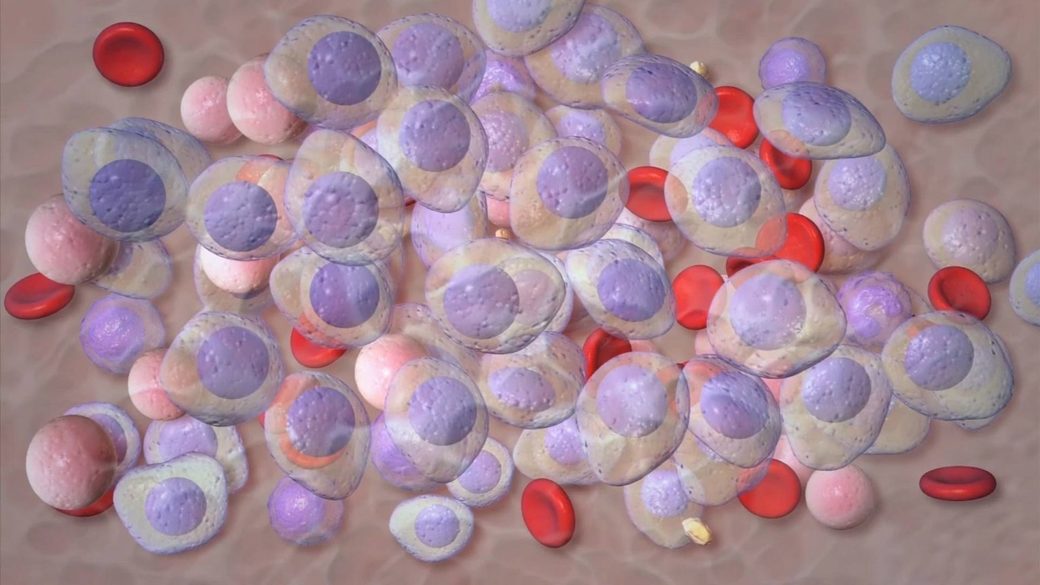 O terapie experimentală pentru o afecţiune precanceroasă a sângelui a generat un răspuns de 100%, potrivit rezultatelor prezentate la reuniunea anuală a Societăţii Internaţionale pentru Mielom