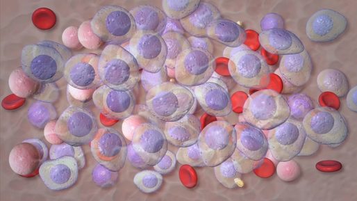 O terapie experimentală pentru o afecţiune precanceroasă a sângelui a generat un răspuns de 100%, potrivit rezultatelor prezentate la reuniunea anuală a Societăţii Internaţionale pentru Mielom