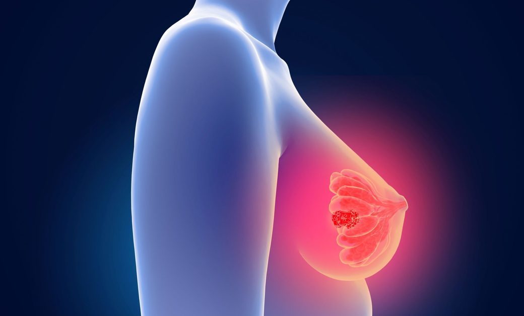 O nouă potenţială abordare de tratament pentru cancerul de sân agresiv