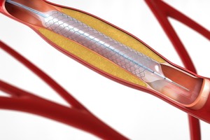 Diferenţe de eficacitate între medicamentele antiagregante la persoanele cu diabet