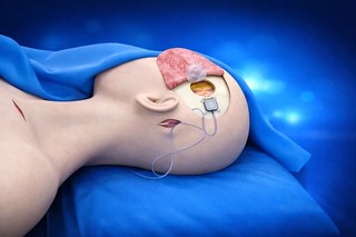 VIDEO Primul studiu clinic din China pentru testarea unui implant cerebral: pacientul paralizat a reuşit să manevreze un scaun cu rotile doar cu ajutorul gândurilor, la câteva zile după intervenţie