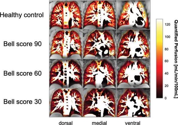 Probleme pulmonare ascunse, descoperite la copiii cu Covid de lungă durată