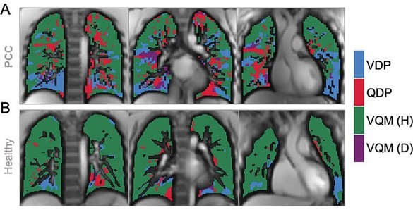 Probleme pulmonare ascunse, descoperite la copiii cu Covid de lungă durată