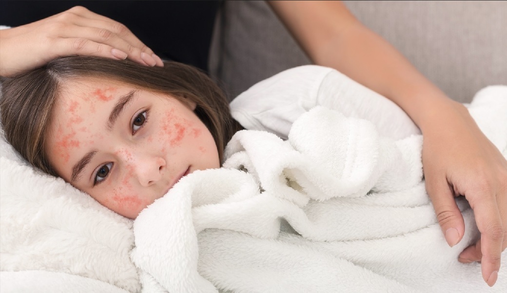 Mai multe ţări europene au pierdut statutul de eliminare a rujeolei, pe fondul scăderii vaccinării