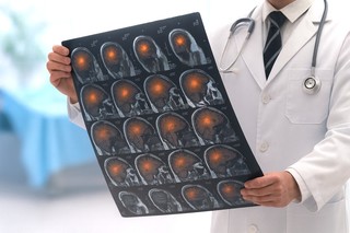 Un nou potenţial tratament pentru pacienţii cu AVC care se prezintă tardiv la urgenţă