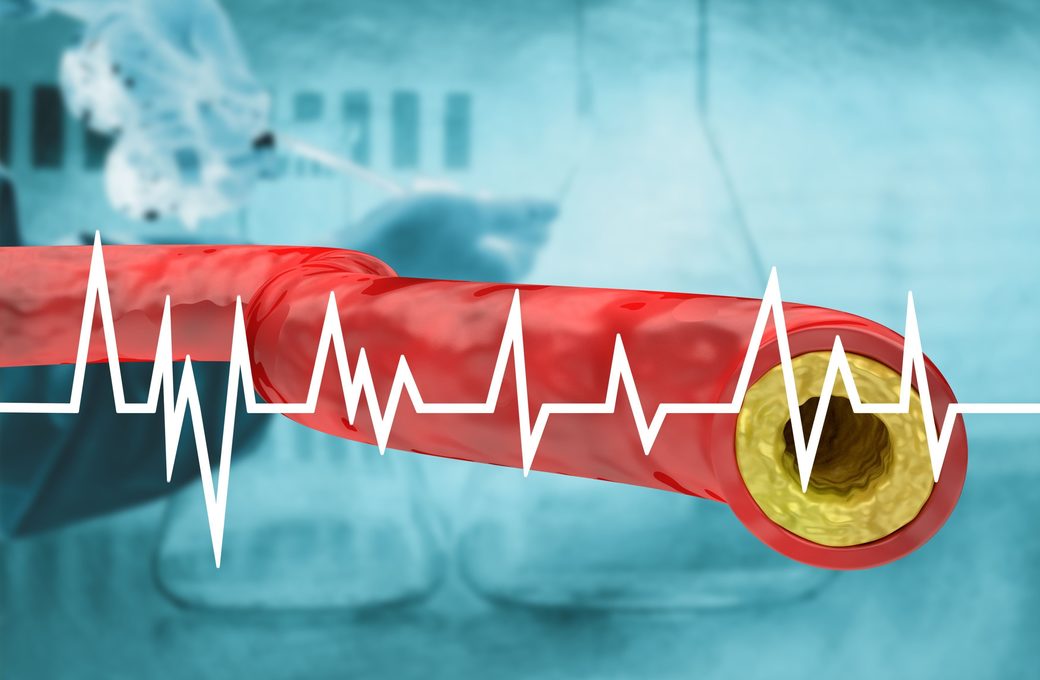 Jumătate dintre cazurile de infarct miocardic apar la persoane considerate cu risc scăzut, avertizează experţii