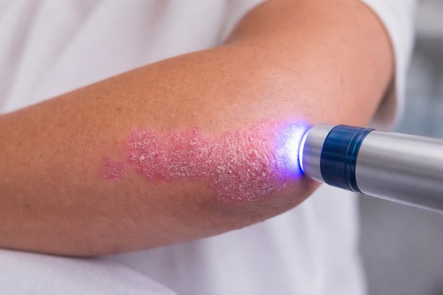 Poza pentru articolul O nouă strategie ar putea permite tratarea psoriazisului fără efecte adverse