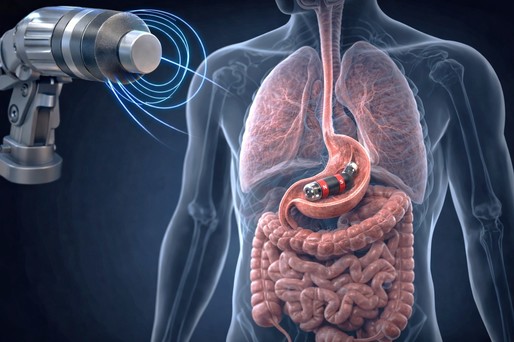 Un robot miniatural sub formă de pastilă ar putea efectua intervenţii gastrointestinale
