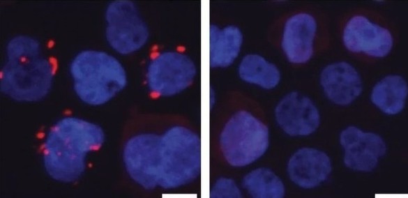 Menţinerea sănătăţii intestinale ar putea contribui la prevenirea leucemiei 