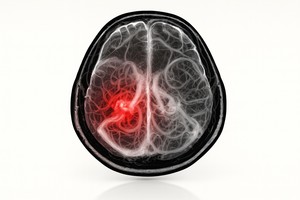 Poluarea aerului, asociată cu un risc crescut de hemoragii cerebrale, într-un studiu realizat în SUA