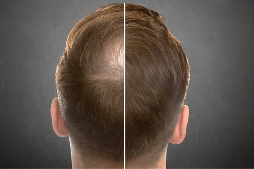 Un compus natural ar putea îmbunătăţi eficienţa tratamentelor pentru căderea părului