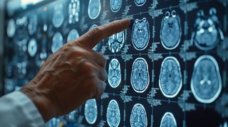 Noi indicii privind cauzele bolilor neurodegenerative precum Alzheimer şi scleroza laterală amiotrofică