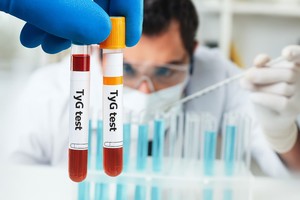 Rezistenţa la insulină accelerează declinul cognitiv în stadiile incipiente ale bolii Alzheimer