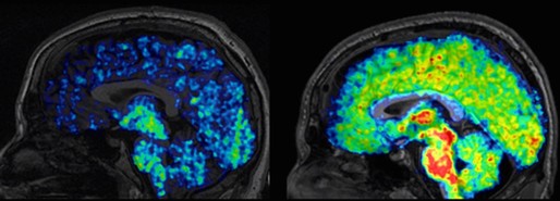 Un nou biomarker ar putea permite depistarea Alzheimerului cu decenii înainte de apariţia simptomelor