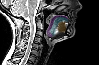 VIDEO O nouă metodă de imagistică asistată de AI, promiţătoare pentru monitorizarea sclerozei laterale amiotrofice