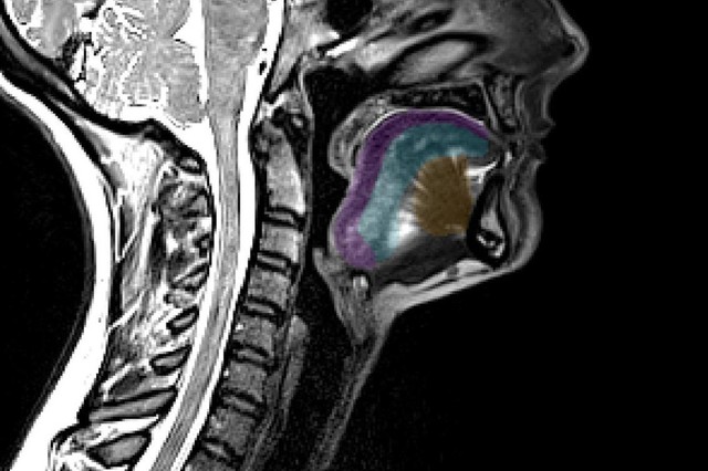 ビデオ 新しい AI 支援画像法が筋萎縮性側索硬化症のモニタリングに有望であることを示す