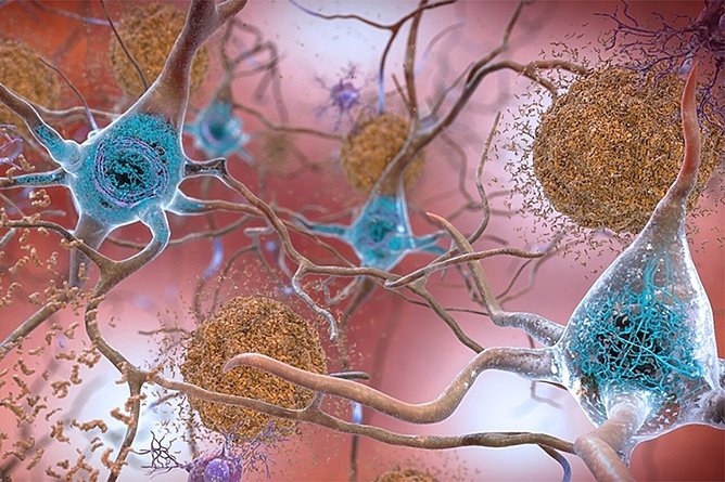 Un mecanism natural din creier care favorizează eliminarea plăcilor toxice implicate în Alzheimer, identificat de oamenii de ştiinţă